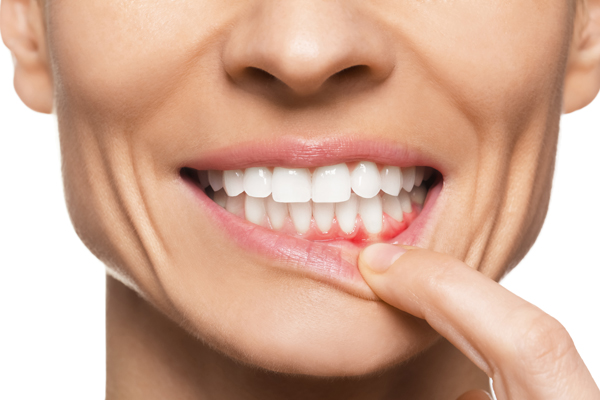 Gum Recession Treatment From A Periodontist