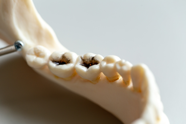 Pain And Root Canals: What You Should Know